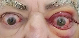 Day after surgery 