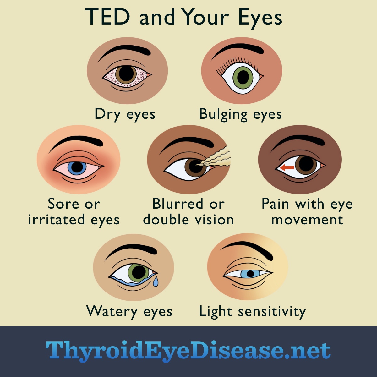 Eyes and TED: Dryness, bulging, sore, blurred vision, pain with movement, tears, light sensitivity.