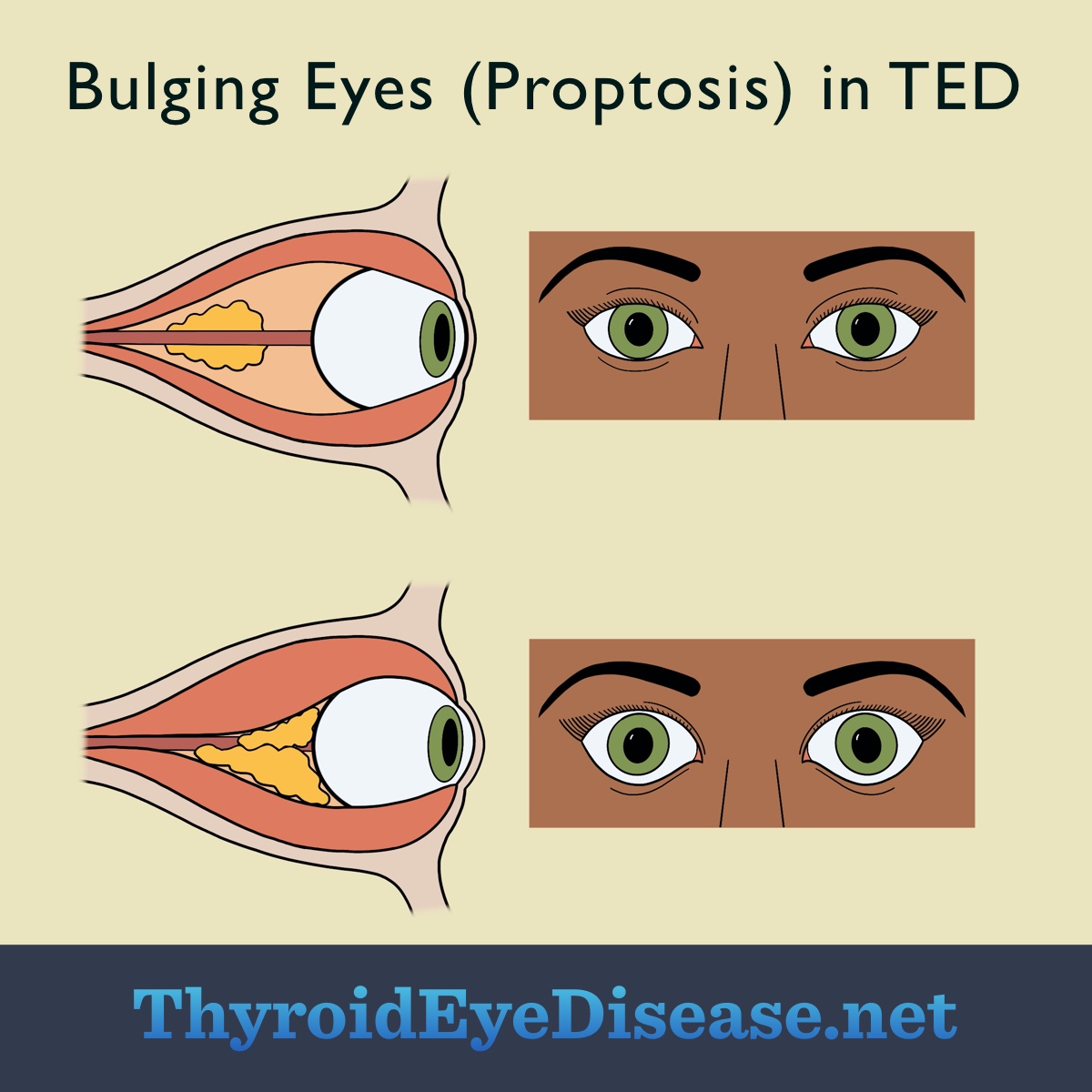 Eye without TED, not bulging. Another eye with TED is bulging and swollen, out of the eye socket.